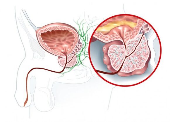 Síntomas de prostatite