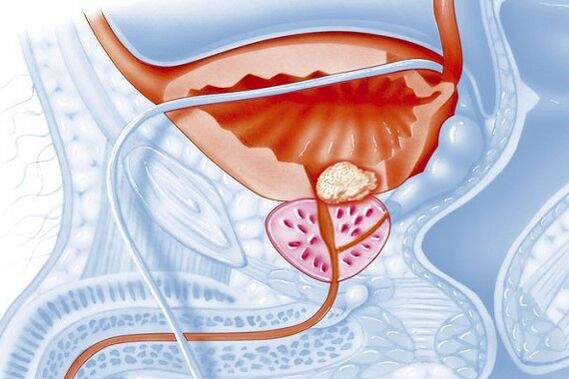 Proceso inflamatorio na próstata