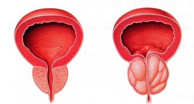 próstata saudable e inflamado con prostatite crónica