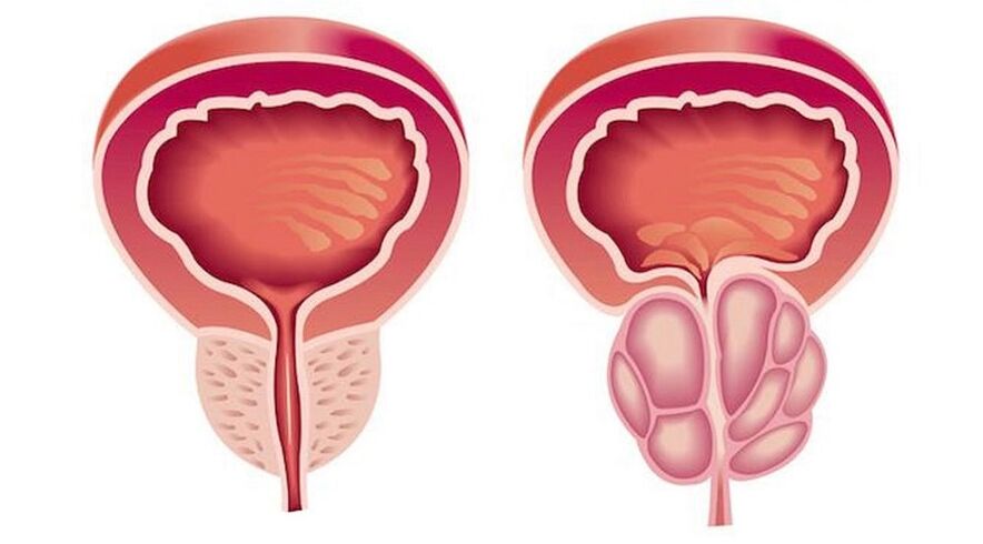 Próstata saudable e inflamada con prostatite