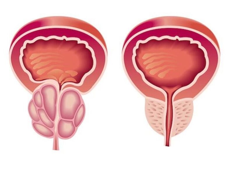 Como é a prostatite